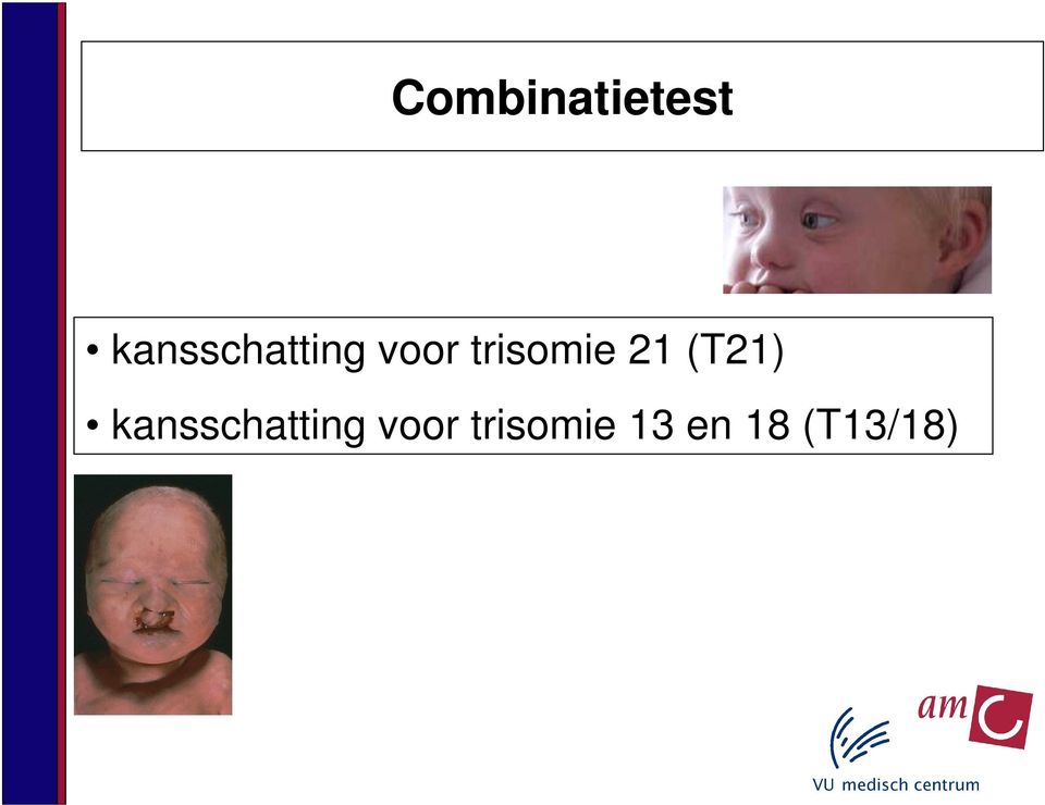 trisomie 21 (T21) 