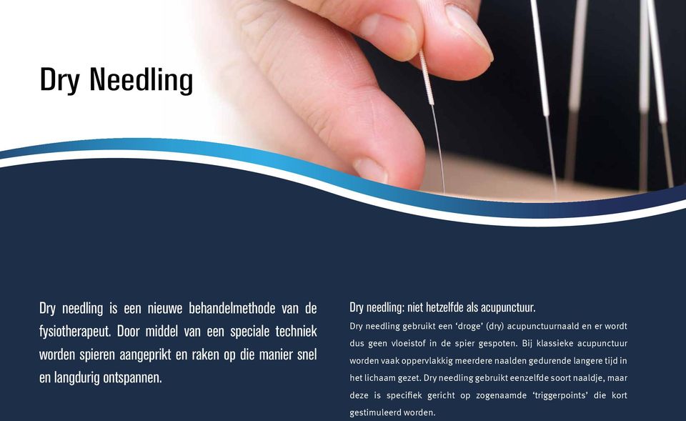 Dry needling: niet hetzelfde als acupunctuur.