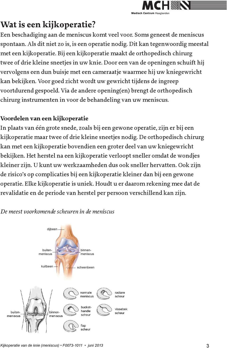 Door een van de openingen schuift hij vervolgens een dun buisje met een cameraatje waarmee hij uw kniegewricht kan bekijken. Voor goed zicht wordt uw gewricht tijdens de ingreep voortdurend gespoeld.