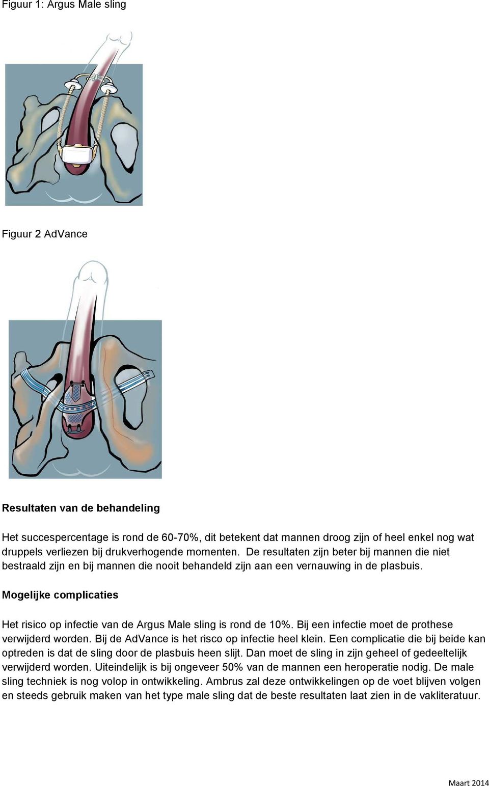 Mogelijke complicaties Het risico op infectie van de Argus Male sling is rond de 10%. Bij een infectie moet de prothese verwijderd worden. Bij de AdVance is het risco op infectie heel klein.