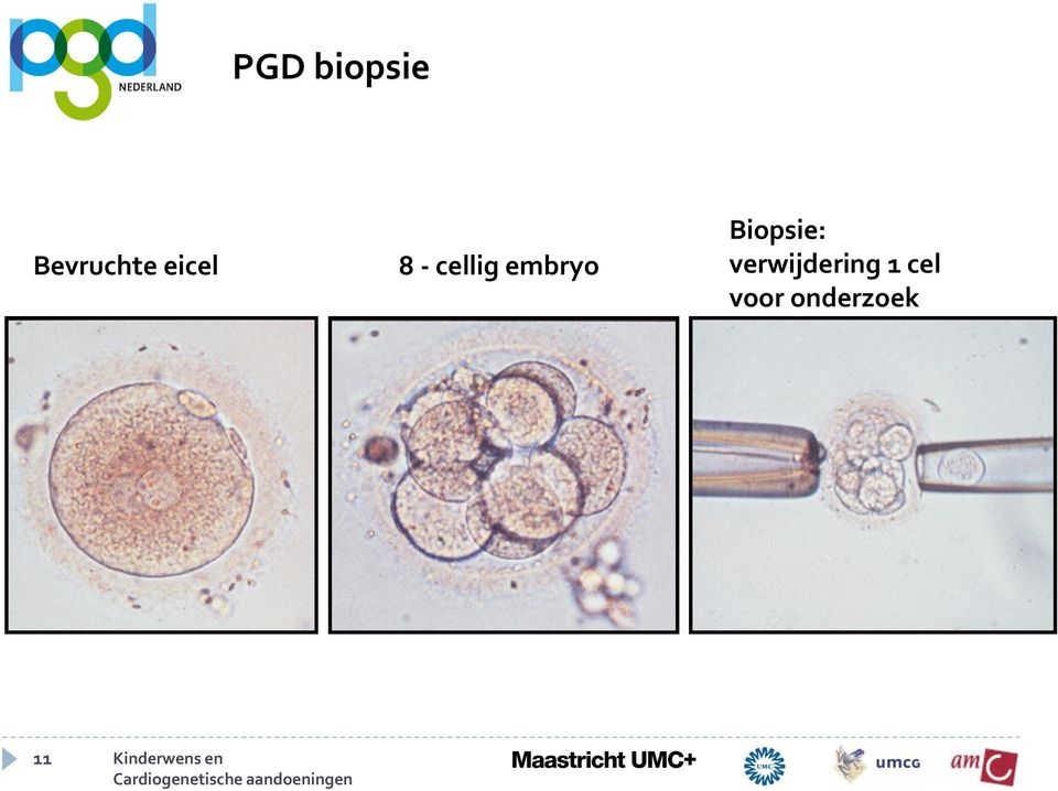 Biopsie: verwijdering 1