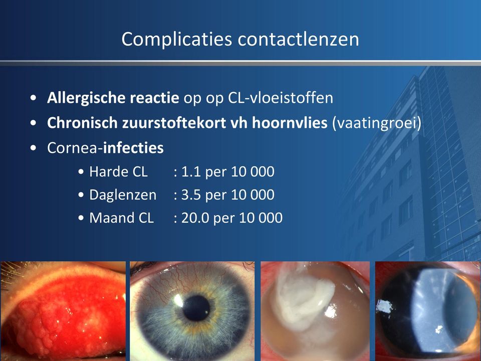 (vaatingroei) Cornea-infecties Harde CL : 1.