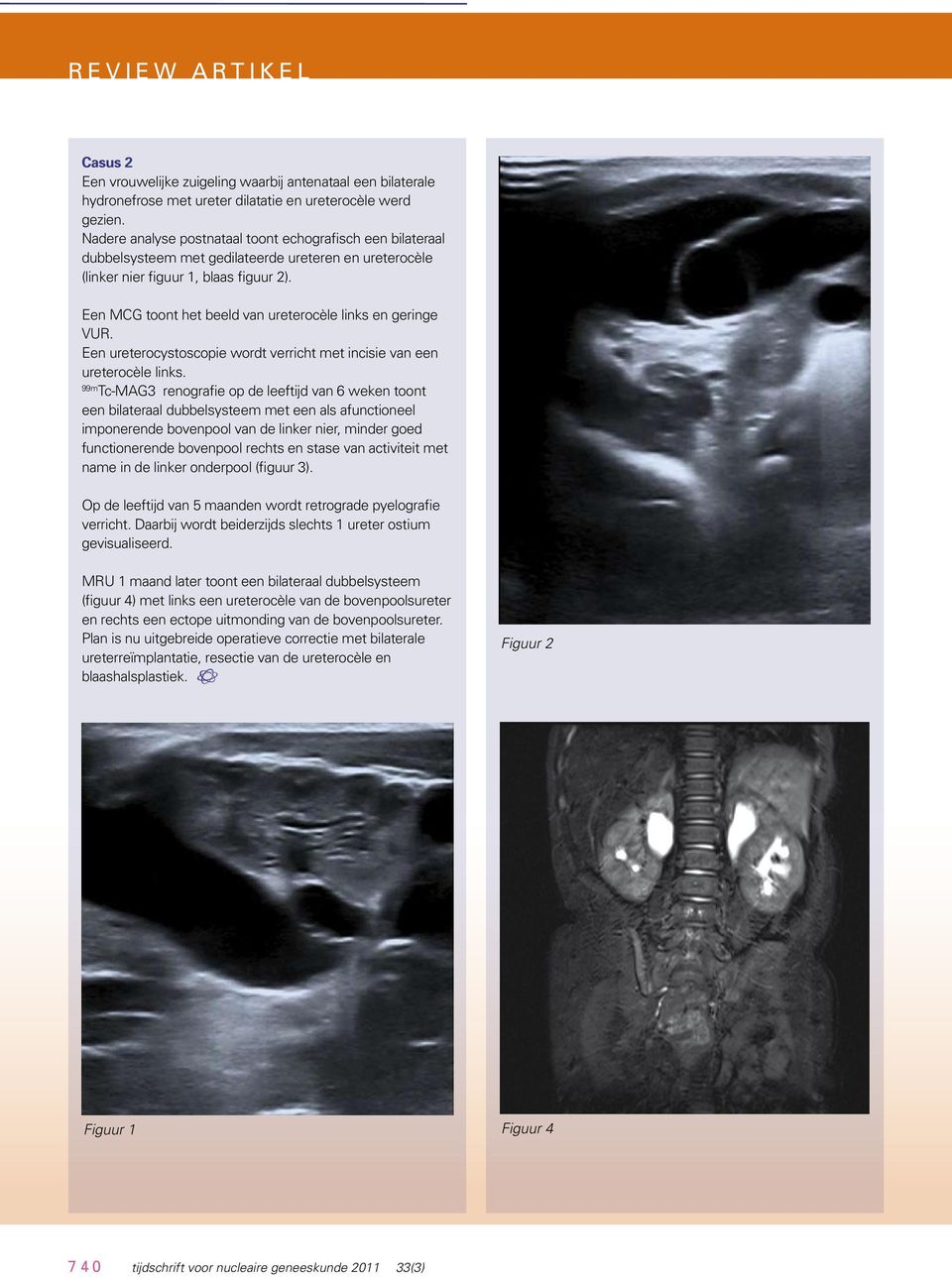 Een MCG toont het beeld van ureterocèle links en geringe VUR. Een ureterocystoscopie wordt verricht met incisie van een ureterocèle links.