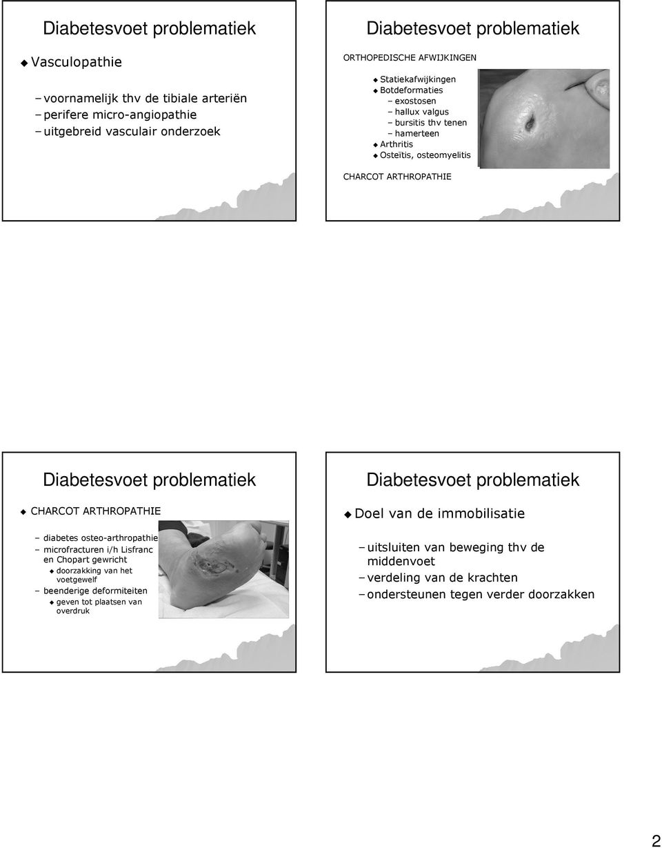 CHARCOT ARTHROPATHIE diabetes osteoosteo-arthropathie microfracturen i/h Lisfranc en Chopart gewricht doorzakking van het voetgewelf beenderige