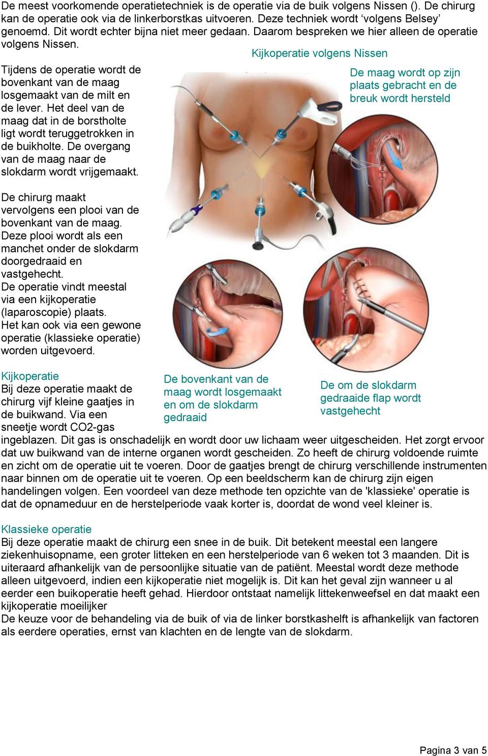 Kijkoperatie volgens Nissen Tijdens de operatie wordt de bovenkant van de maag losgemaakt van de milt en de lever. Het deel van de maag dat in de borstholte ligt wordt teruggetrokken in de buikholte.