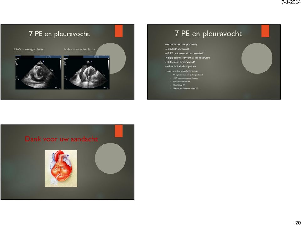 vals aneurysma -NB: fibrine f tumrweefsel?