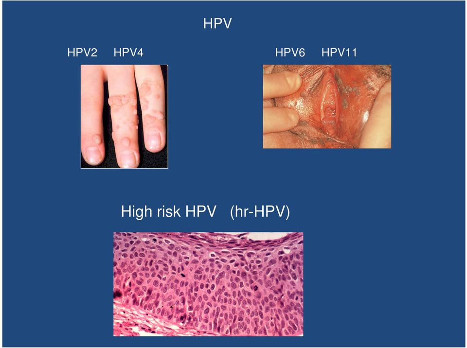 HPV11 High