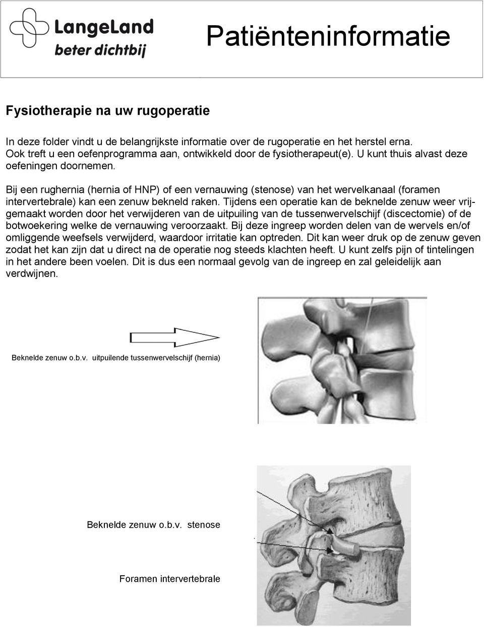 Tijdens een operatie kan de beknelde zenuw weer vrijgemaakt worden door het verwijderen van de uitpuiling van de tussenwervelschijf (discectomie) of de botwoekering welke de vernauwing veroorzaakt.