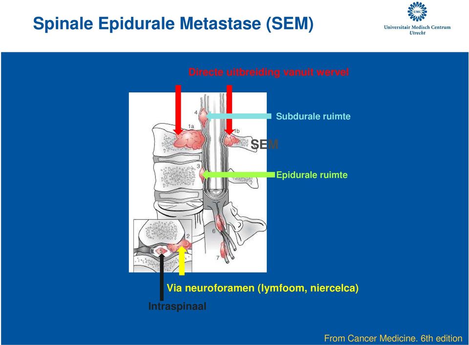 Epidurale ruimte Via neuroforamen (lymfoom,