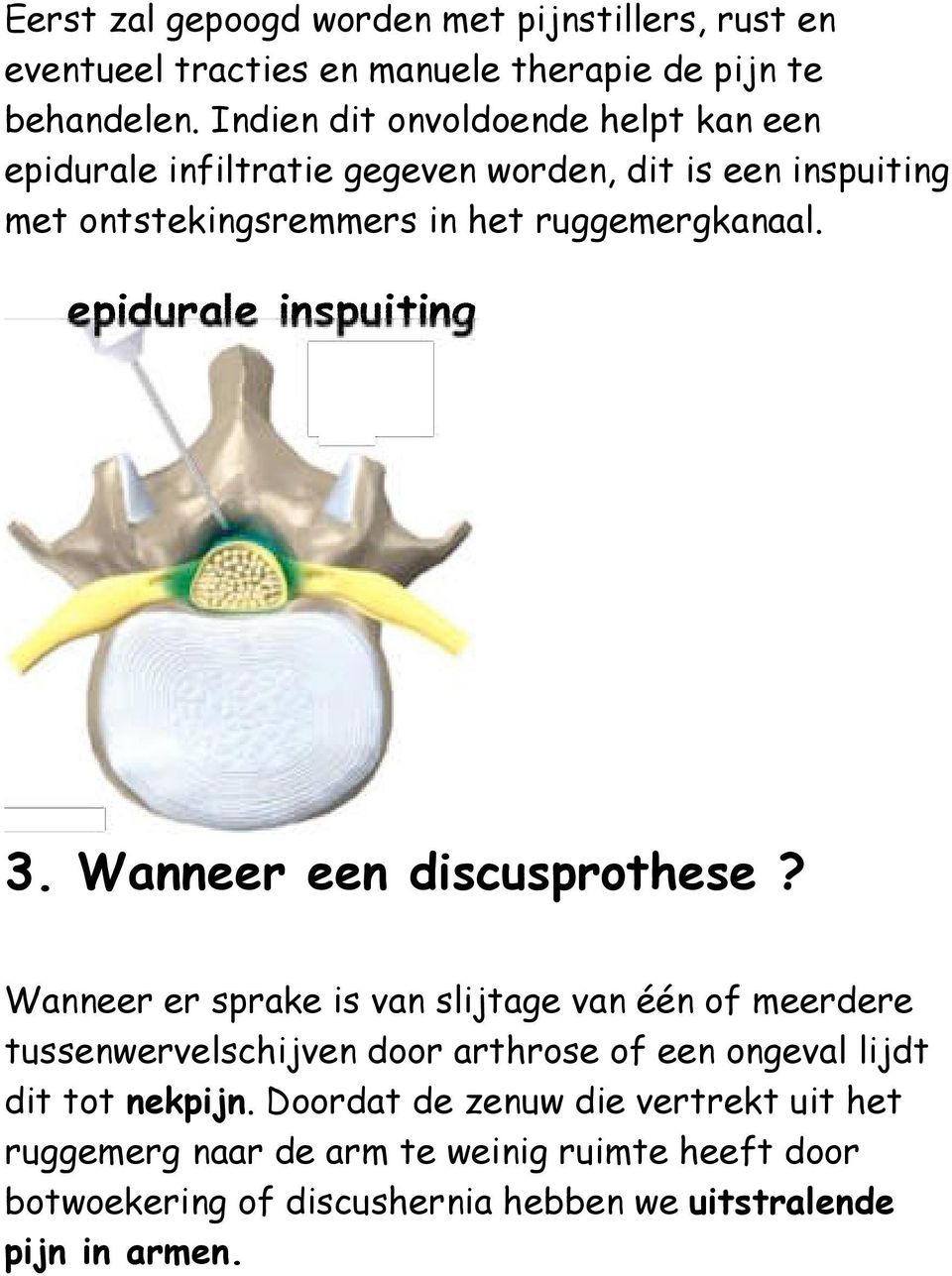 3. Wanneer een discusprothese?