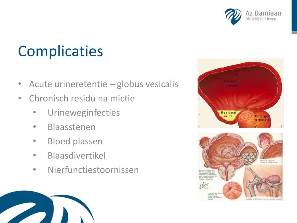 Urineweginfecties Blaasstenen Bloed