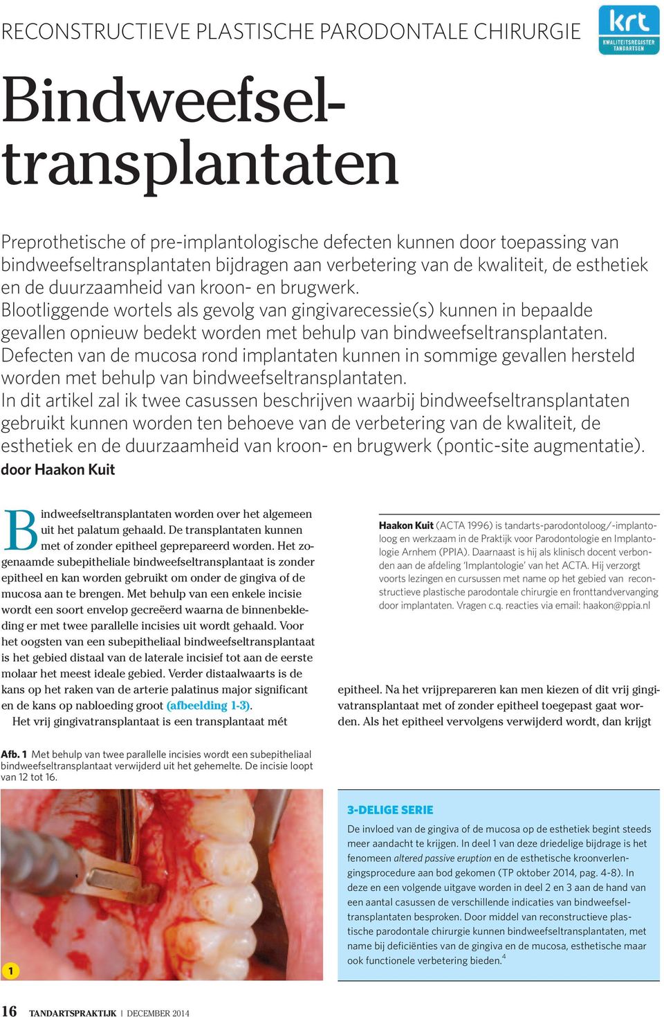 Blootliggende wortels als gevolg van gingivarecessie(s) kunnen in bepaalde gevallen opnieuw bedekt worden met behulp van bindweefseltransplantaten.