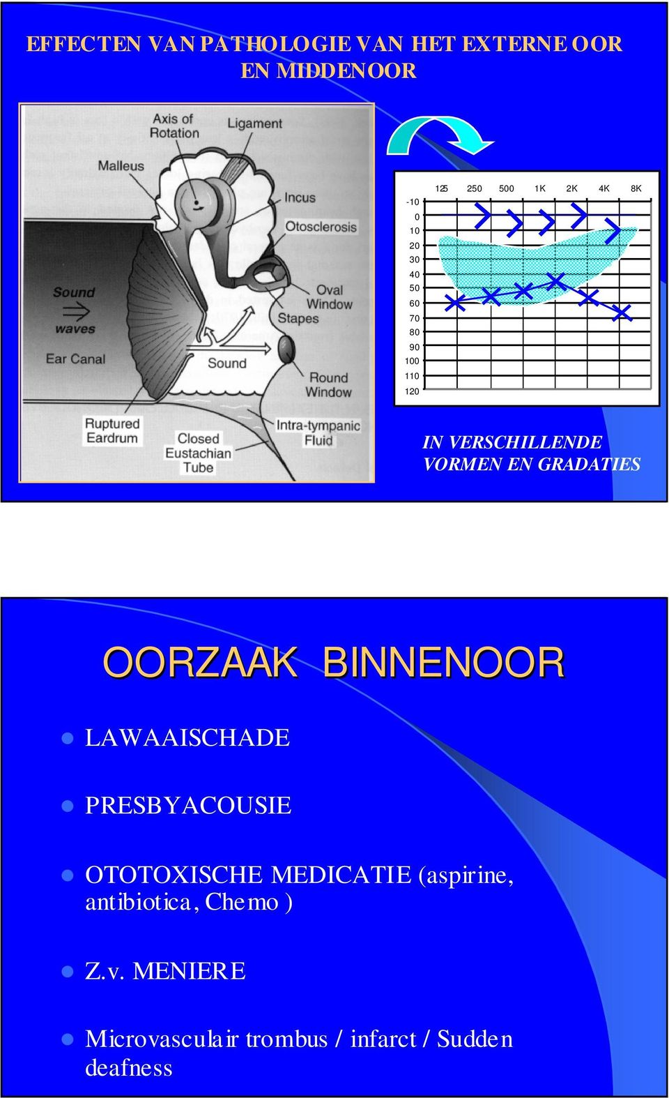 OORZAAK BINNENOOR LAWAAISCHADE PRESBYACOUSIE OTOTOXISCHE MEDICATIE (aspirine,