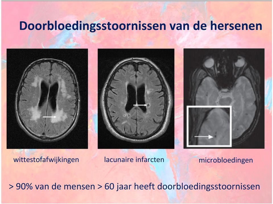 infarcten microbloedingen > 90% van de