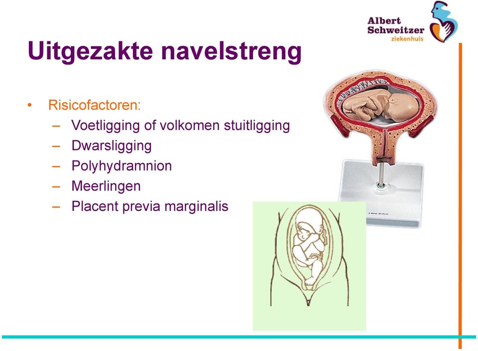 volkomen stuitligging Dwarsligging