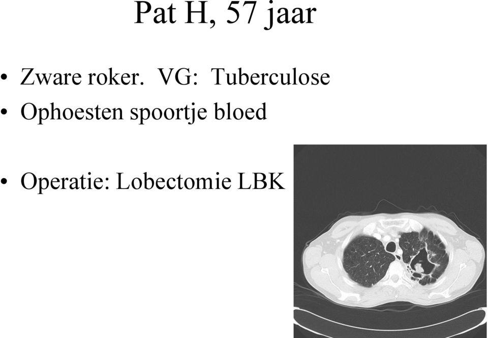 VG: Tuberculose