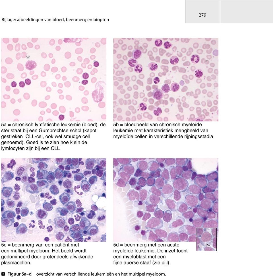 Goed is te zien hoe klein de lymfocyten zijn bij een CLL 5b = bloedbeeld van chronisch myeloïde leukemie met karakteristiek mengbeeld van myeloïde cellen in verschillende