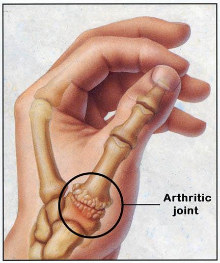 Orthopedie Sardellenplastiek Operatieve behandeling duimartrose Inleiding Uw behandelend arts heeft met u afgesproken dat u binnenkort in het ziekenhuis wordt opgenomen voor een operatie.