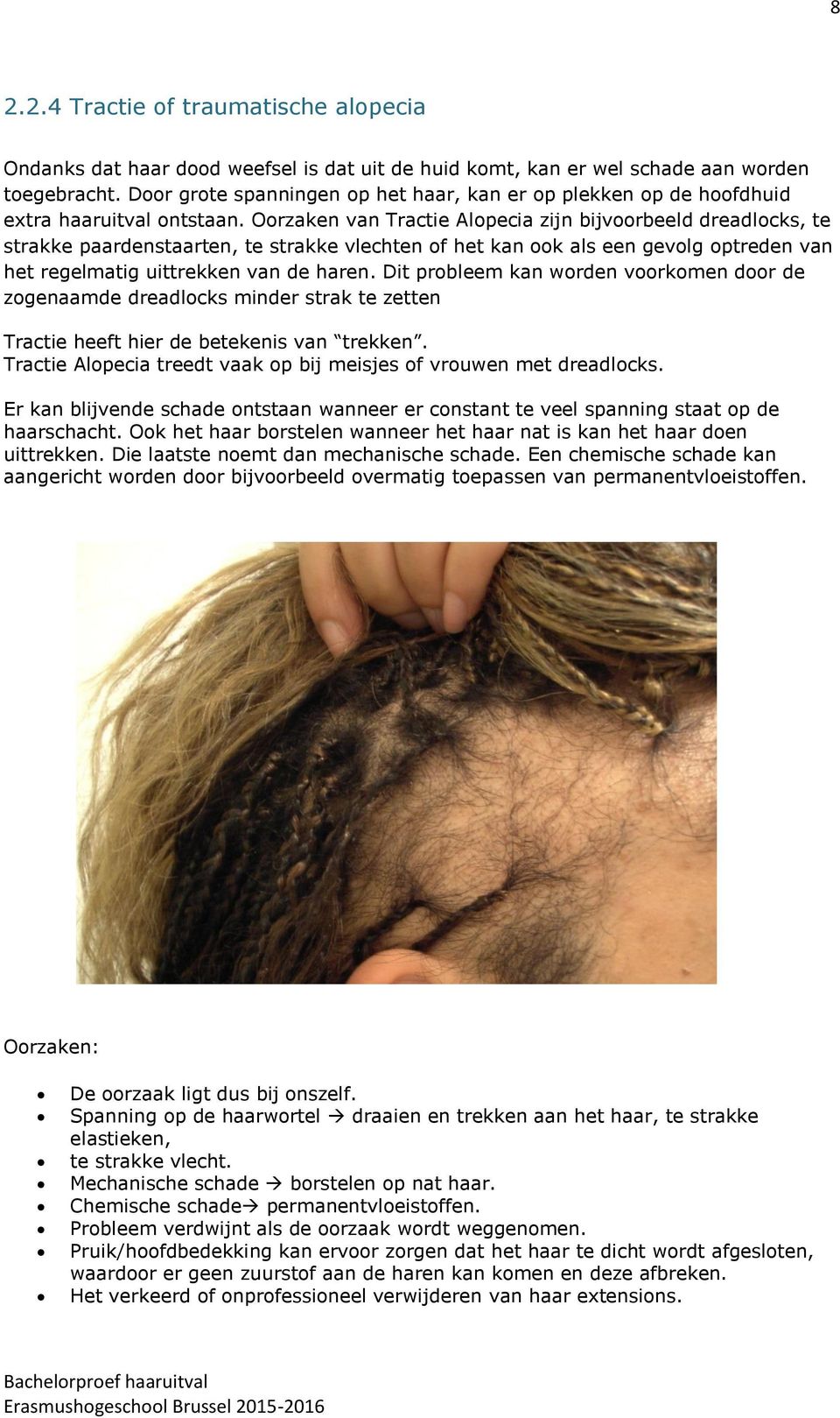 Oorzaken van Tractie Alopecia zijn bijvoorbeeld dreadlocks, te strakke paardenstaarten, te strakke vlechten of het kan ook als een gevolg optreden van het regelmatig uittrekken van de haren.
