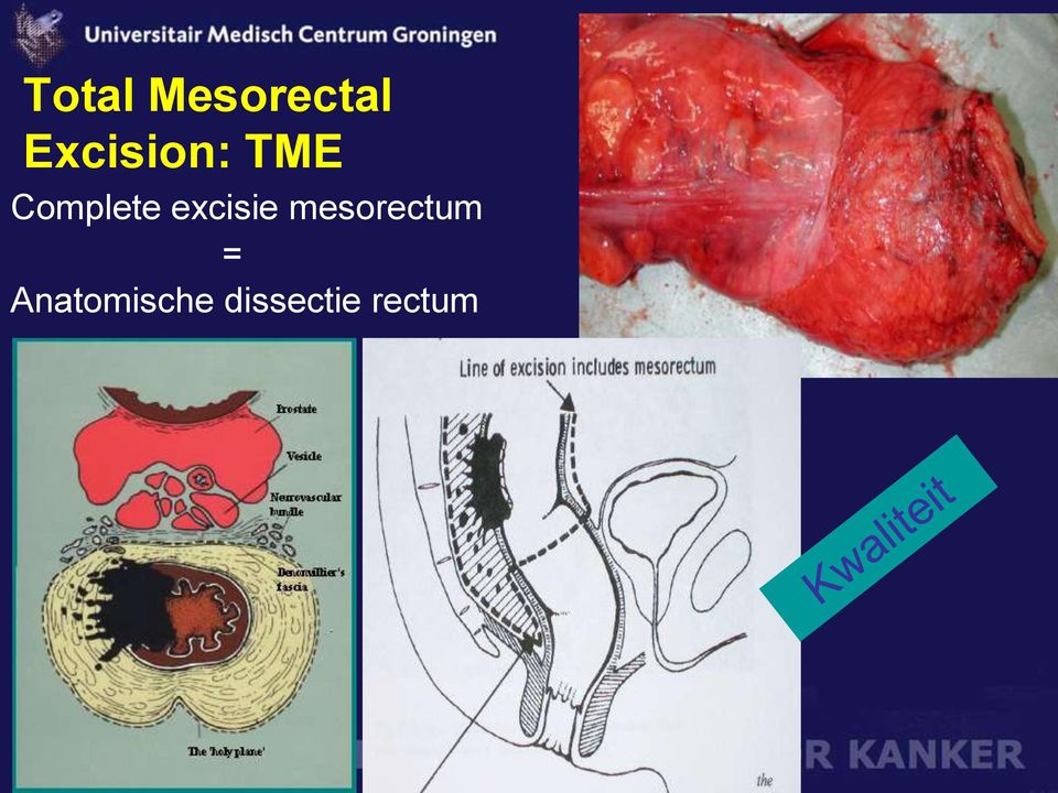 excisie mesorectum =