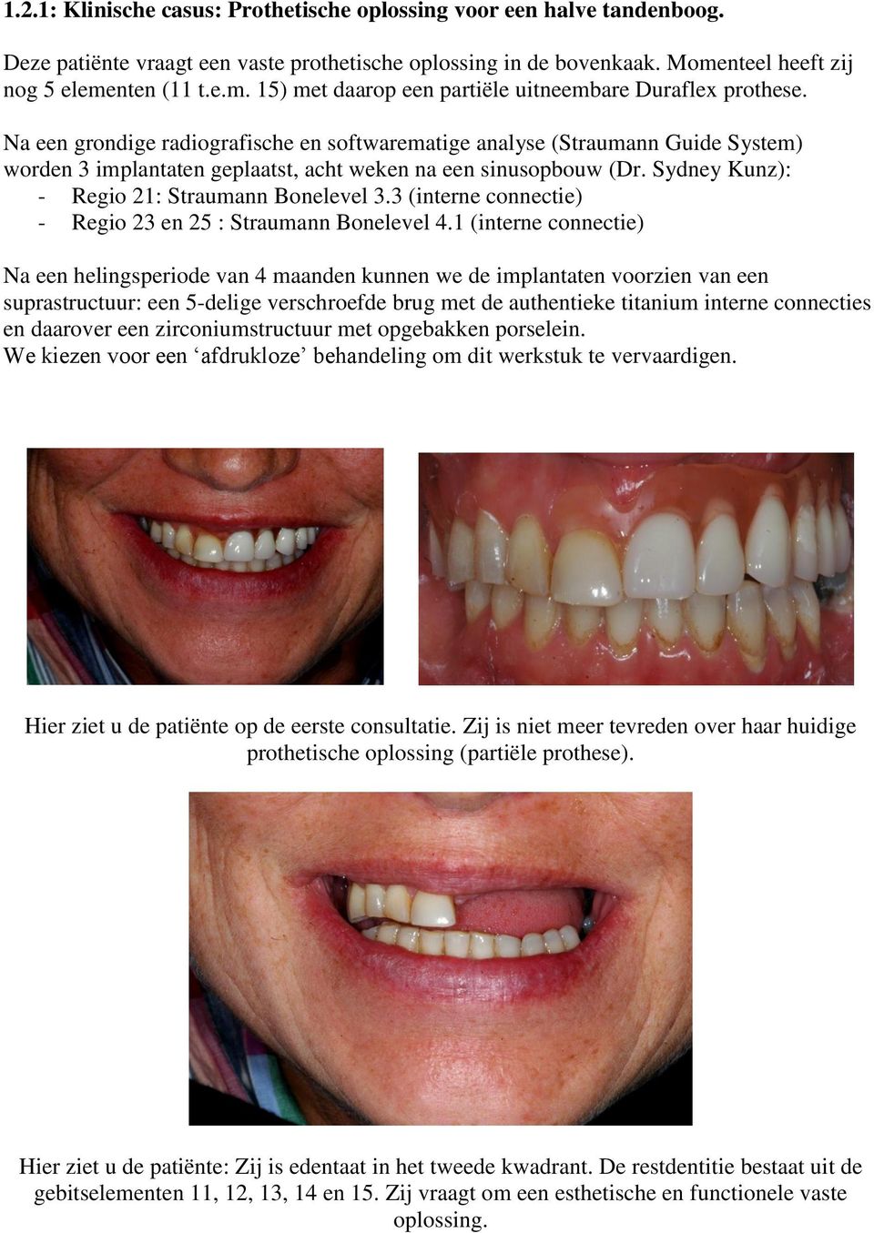 Na een grondige radiografische en softwarematige analyse (Straumann Guide System) worden 3 implantaten geplaatst, acht weken na een sinusopbouw (Dr. Sydney Kunz): - Regio 21: Straumann Bonelevel 3.