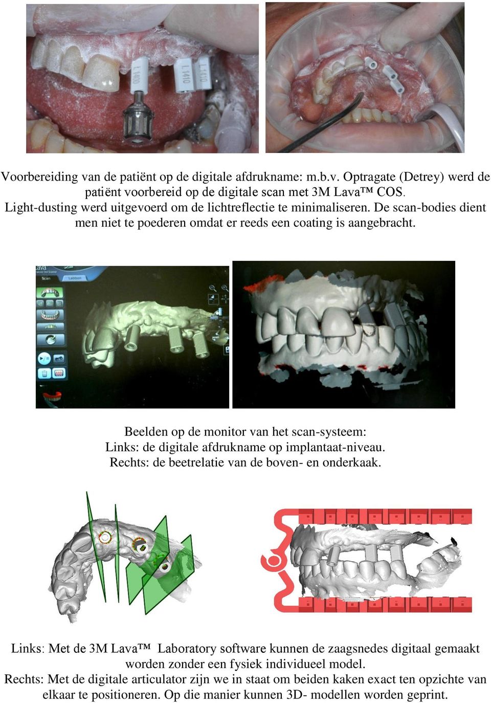 Beelden op de monitor van het scan-systeem: Links: de digitale afdrukname op implantaat-niveau. Rechts: de beetrelatie van de boven- en onderkaak.