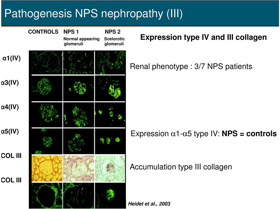 Renal phenotype : 3/7 NPS patients α3(iv) α4(iv) α5(iv) Expression α1-α5 type