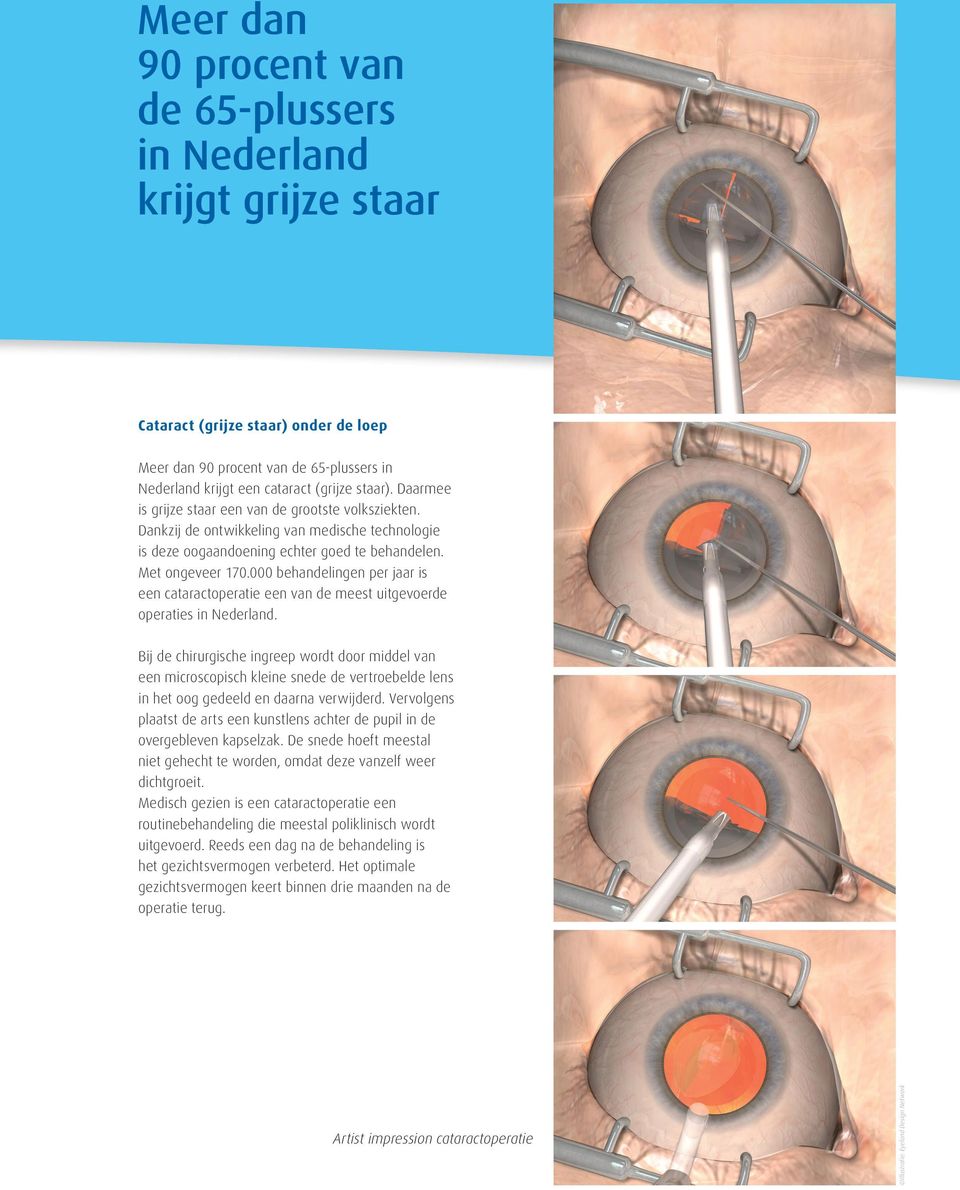 000 behandelingen per jaar is een cataractoperatie een van de meest uitgevoerde operaties in Nederland.