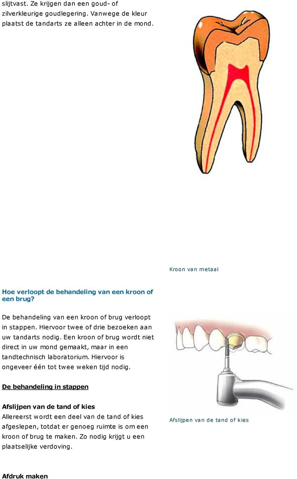 Hiervoor twee of drie bezoeken aan uw tandarts nodig. Een kroon of brug wordt niet direct in uw mond gemaakt, maar in een tandtechnisch laboratorium.