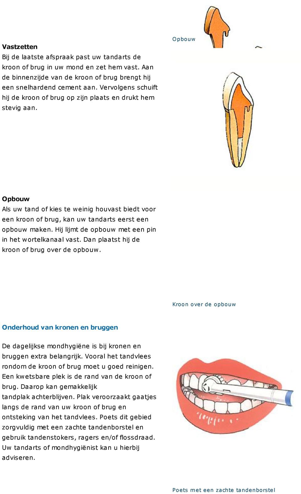 Opbouw Opbouw Als uw tand of kies te weinig houvast biedt voor een kroon of brug, kan uw tandarts eerst een opbouw maken. Hij lijmt de opbouw met een pin in het wortelkanaal vast.