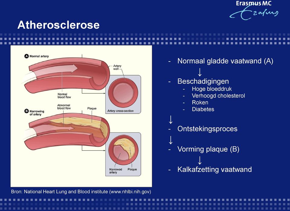 Ontstekingsproces - Vorming plaque (B) - Kalkafzetting