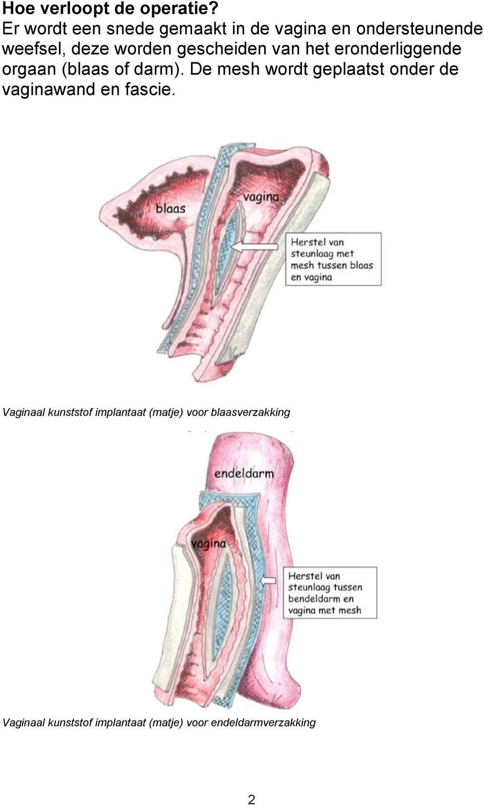 gescheiden van het eronderliggende orgaan (blaas of darm).