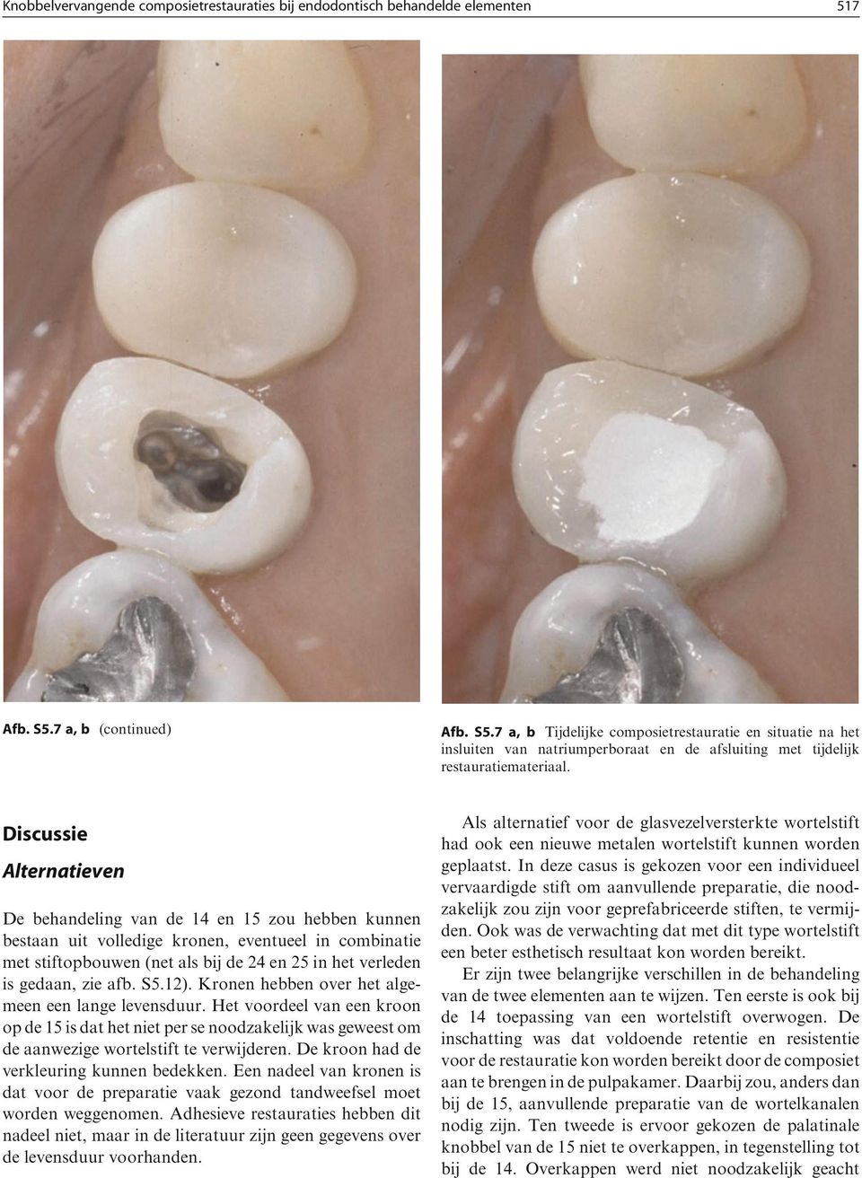 Discussie Alternatieven De behandeling van de 14 en 15 zou hebben kunnen bestaan uit volledige kronen, eventueel in combinatie met stiftopbouwen (net als bij de 24 en 25 in het verleden is gedaan,