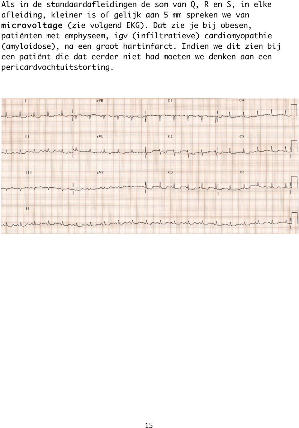 Dat zie je bij obesen, patiënten met emphyseem, igv (infiltratieve) cardiomyopathie