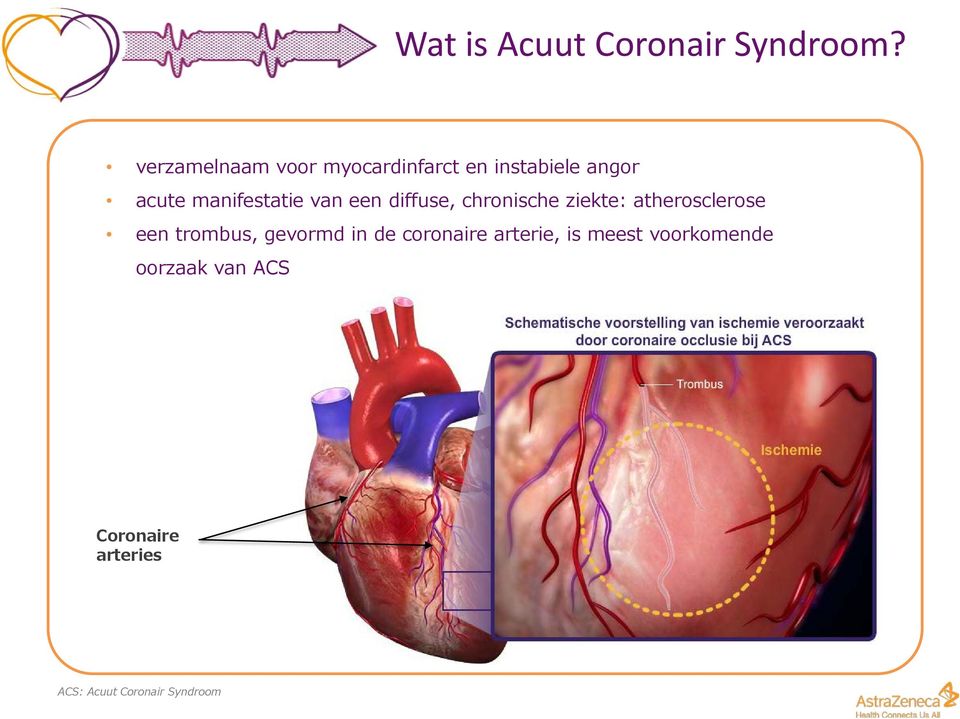 van een diffuse, chronische ziekte: atherosclerose een trombus, gevormd