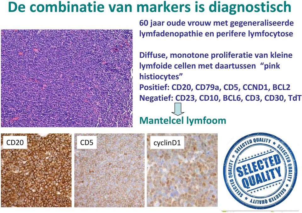 lymfoidecellenmet daartussen pink histiocytes Positief: CD20, CD79a, CD5, CCND1,