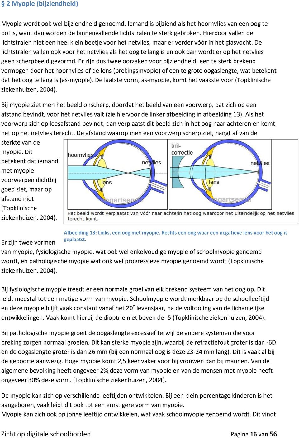 De lichtstralen vallen ook voor het netvlies als het oog te lang is en ook dan wordt er op het netvlies geen scherpbeeld gevormd.