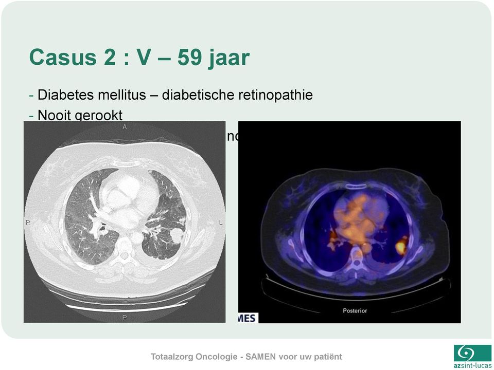 - Nooit gerookt - RX thorax