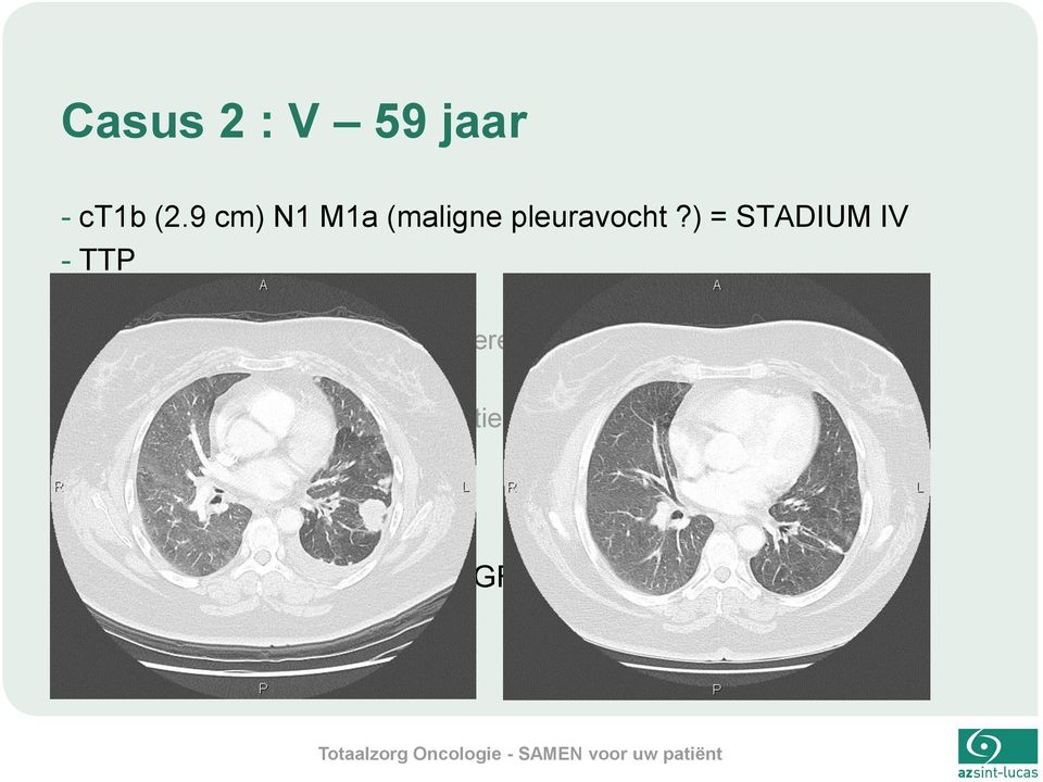 overexpressie in 90% van de cellen -ALK : kleuring negatief