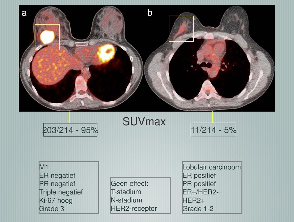 effect: T-stadium N-stadium HER2-receptor Lobulair