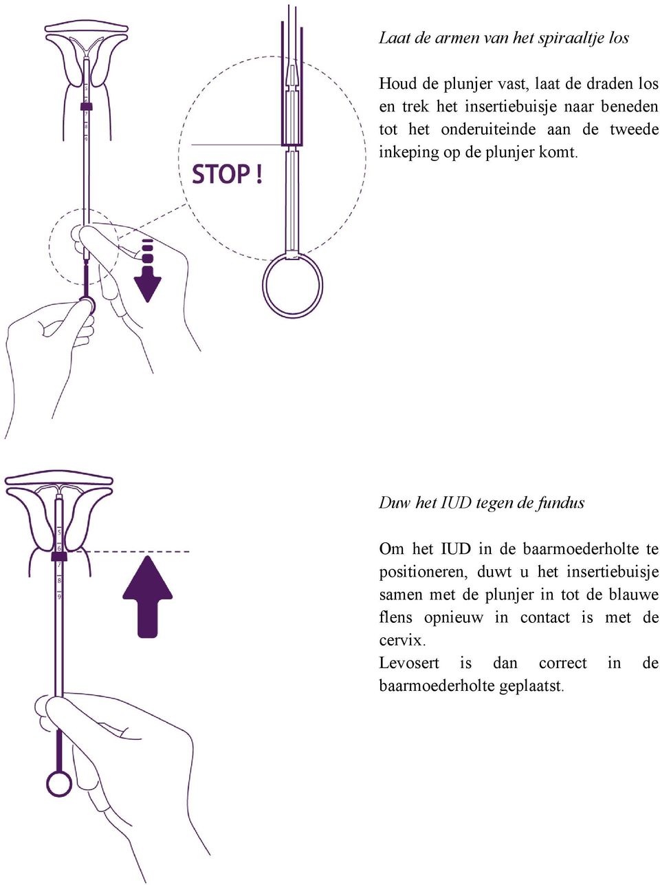Duw het IUD tegen de fundus Om het IUD in de baarmoederholte te positioneren, duwt u het insertiebuisje