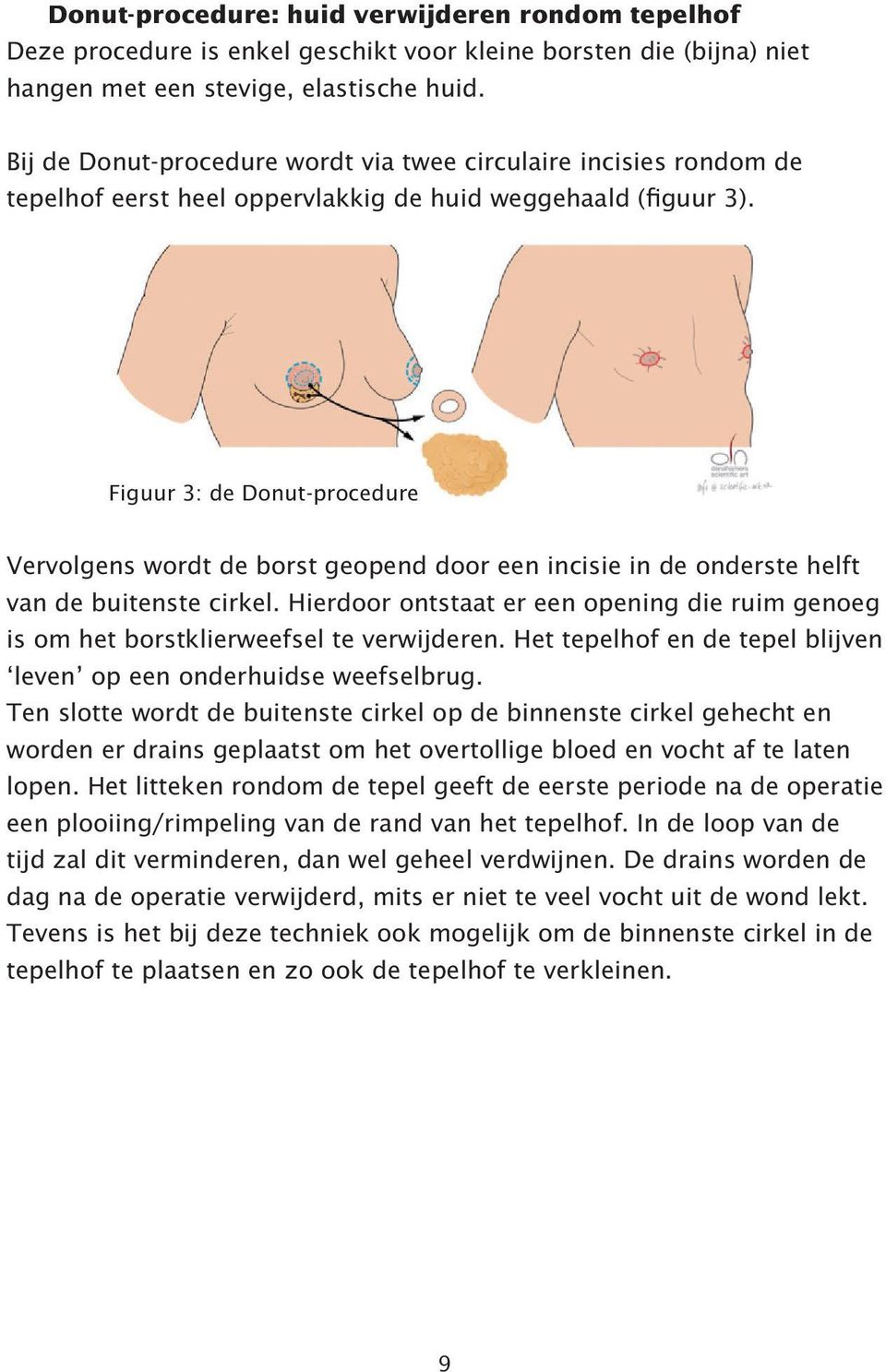 Figuur 3: de Donut-procedure Vervolgens wordt de borst geopend door een incisie in de onderste helft van de buitenste cirkel.