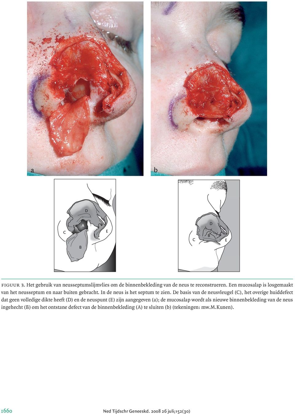 De basis van de neusvleugel (C), het overige huiddefect dat geen volledige dikte heeft (D) en de neuspunt (E) zijn aangegeven (a); de