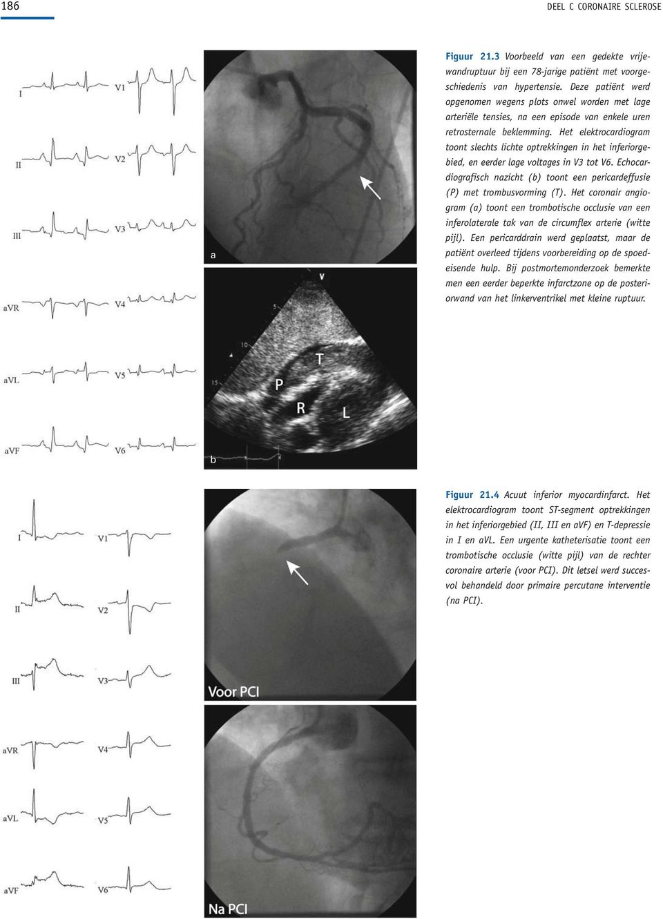 Het elektrocardiogram toont slechts lichte optrekkingen in het inferiorgebied, en eerder lage voltages in V3 tot V6.