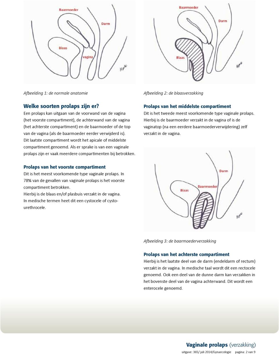 eerder verwijderd is). Dit laatste compartiment wordt het apicale of middelste compartiment genoemd. Als er sprake is van een vaginale prolaps zijn er vaak meerdere compartimenten bij betrokken.