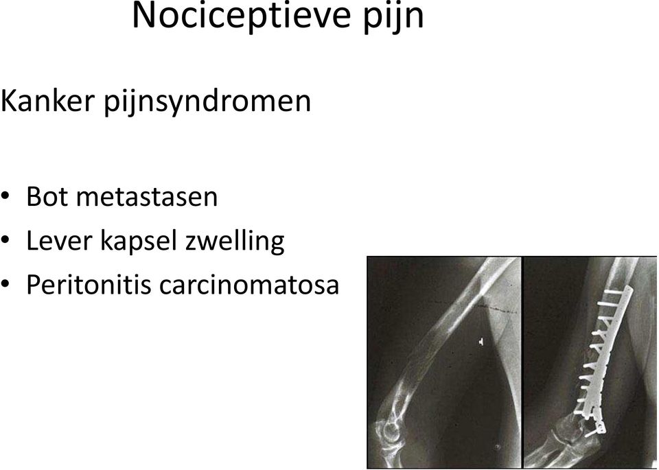 metastasen Lever kapsel