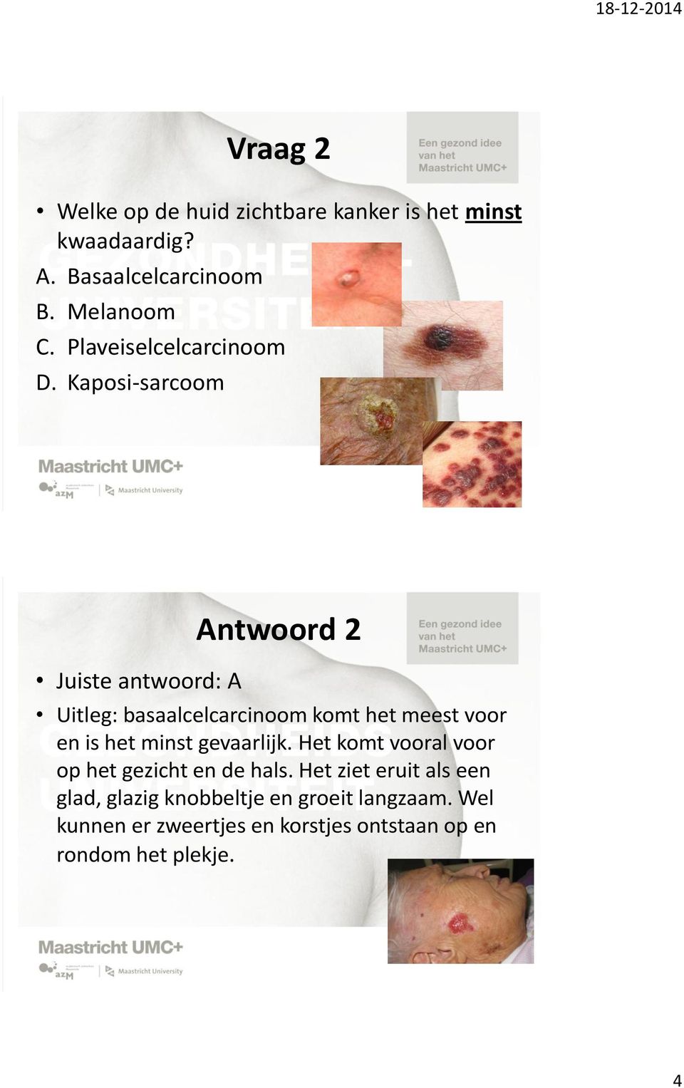 Kaposi-sarcoom Juiste antwoord: A Antwoord 2 Uitleg: basaalcelcarcinoom komt het meest voor en is het minst