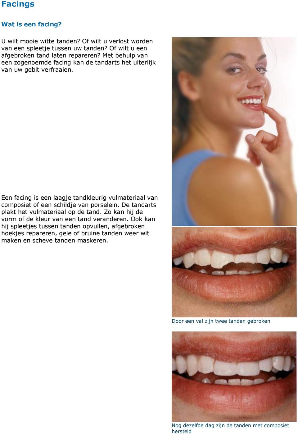 Een facing is een laagje tandkleurig vulmateriaal van composiet of een schildje van porselein. De tandarts plakt het vulmateriaal op de tand.