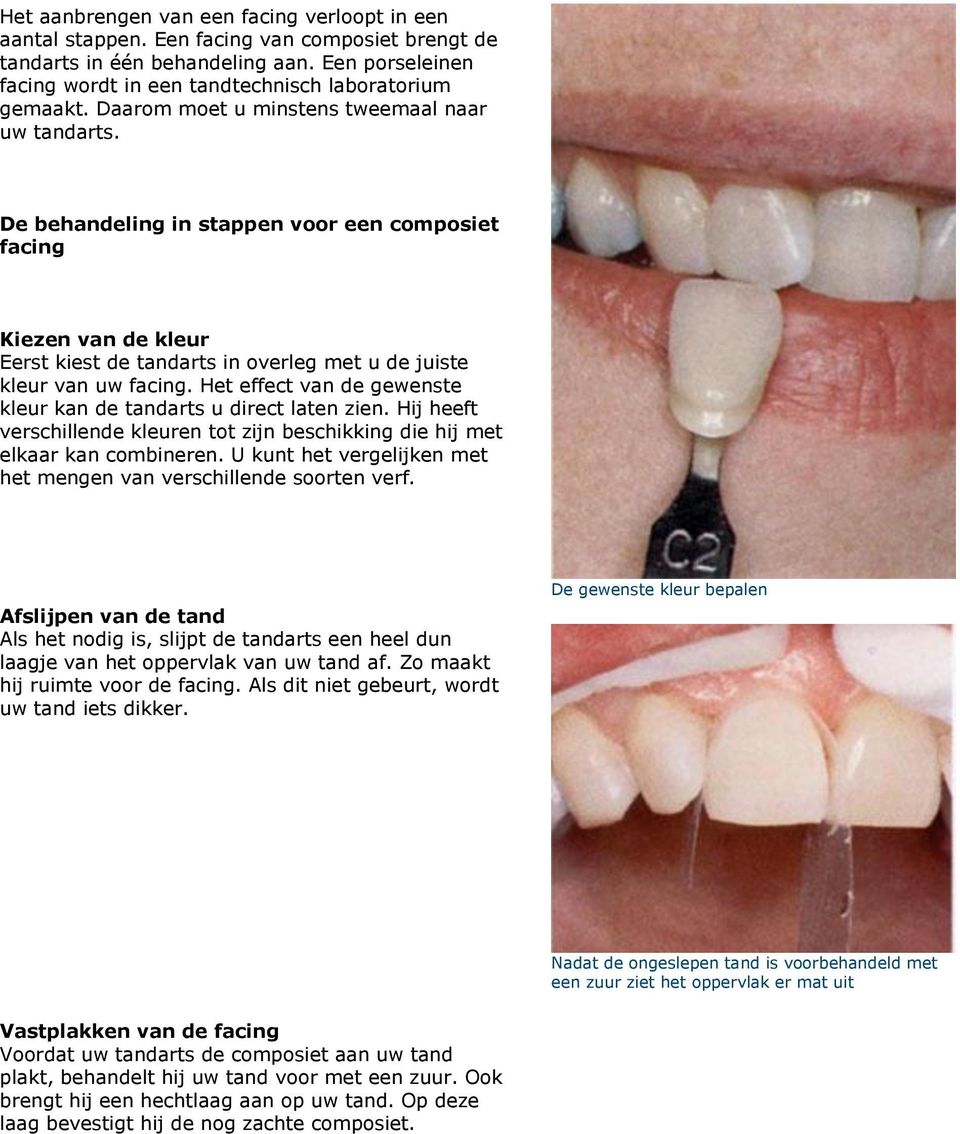 De behandeling in stappen voor een composiet facing Kiezen van de kleur Eerst kiest de tandarts in overleg met u de juiste kleur van uw facing.