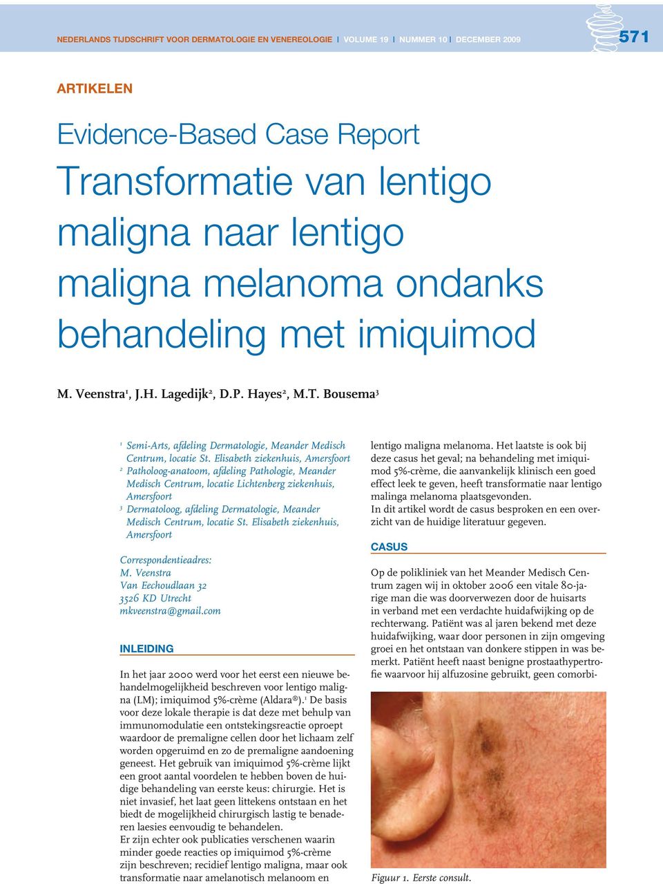 Patiënt heeft naast benigne prostaathypertrofie waarvoor hij alfuzosine gebruikt, geen comorbiartikelen Evidence-Based Case Report Transformatie van lentigo maligna naar lentigo maligna melanoma